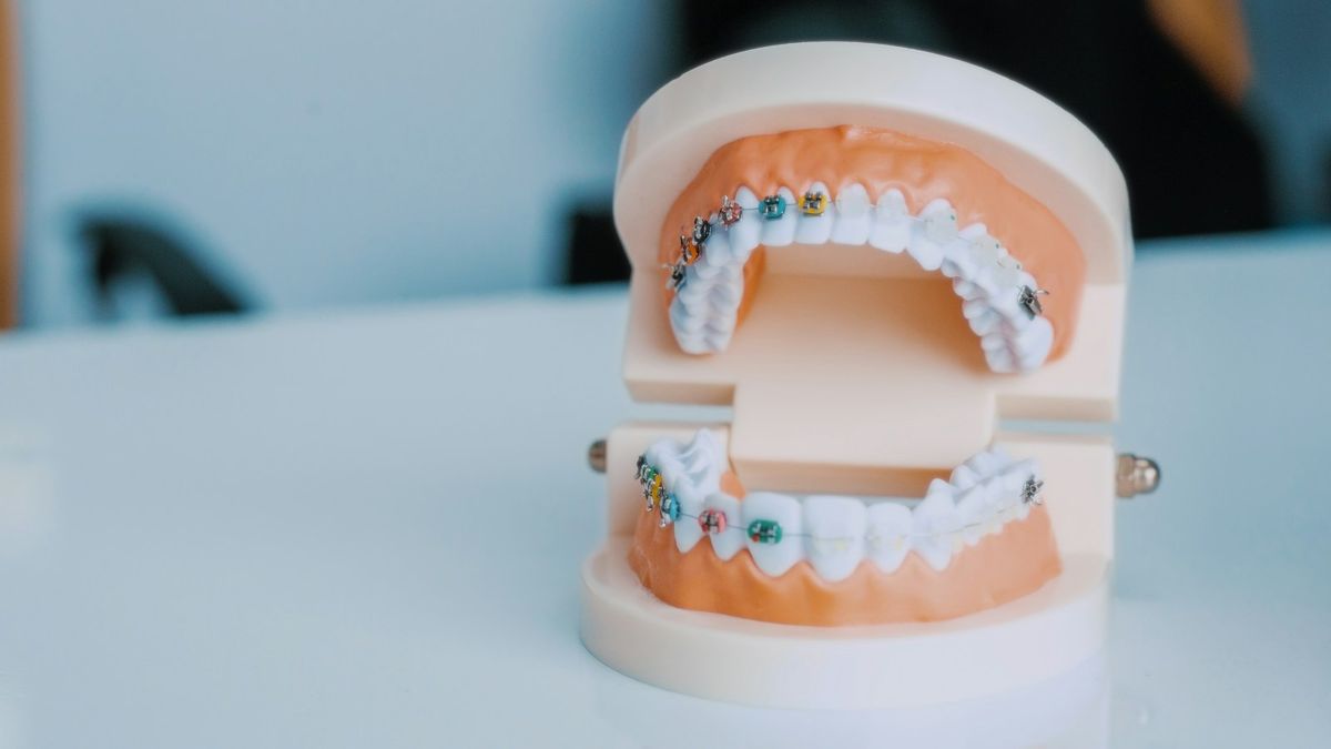 Teeth model with braces (illustrative stock photo)